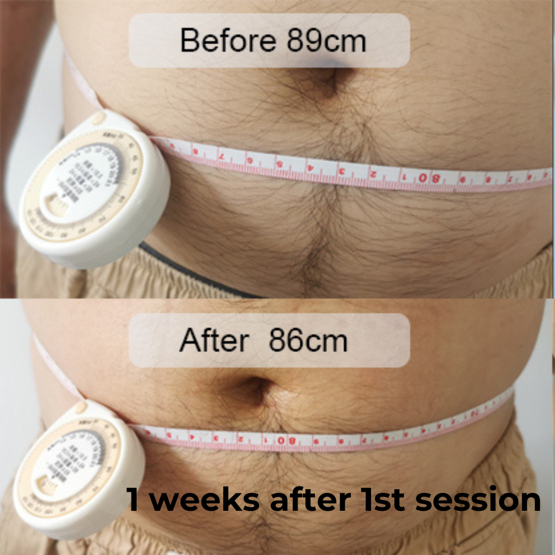SculptAssure™️ 1060nm Diode Laser Weight Loss Machine