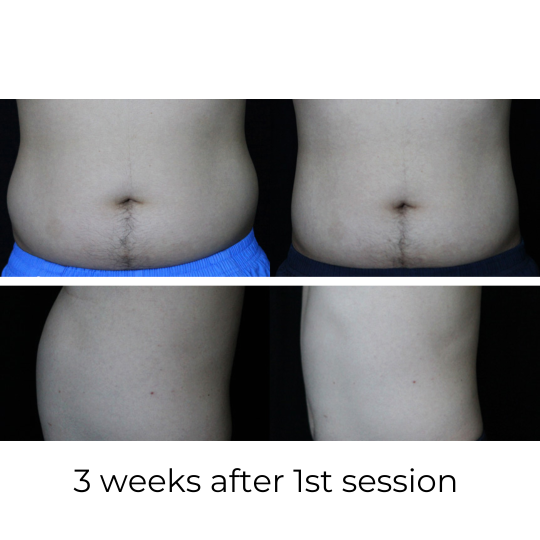 SculptAssure™️ 1060nm Diode Laser Weight Loss Machine
