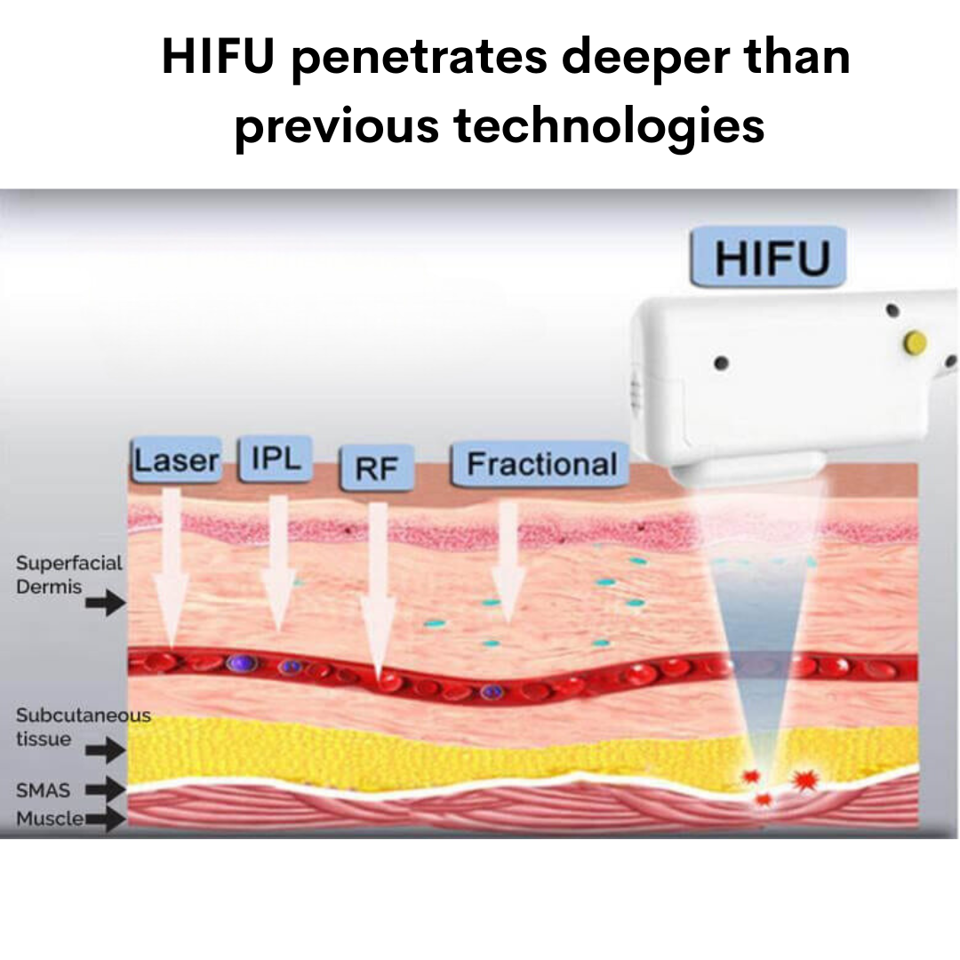 Máquina HIFU de estiramiento facial 9D