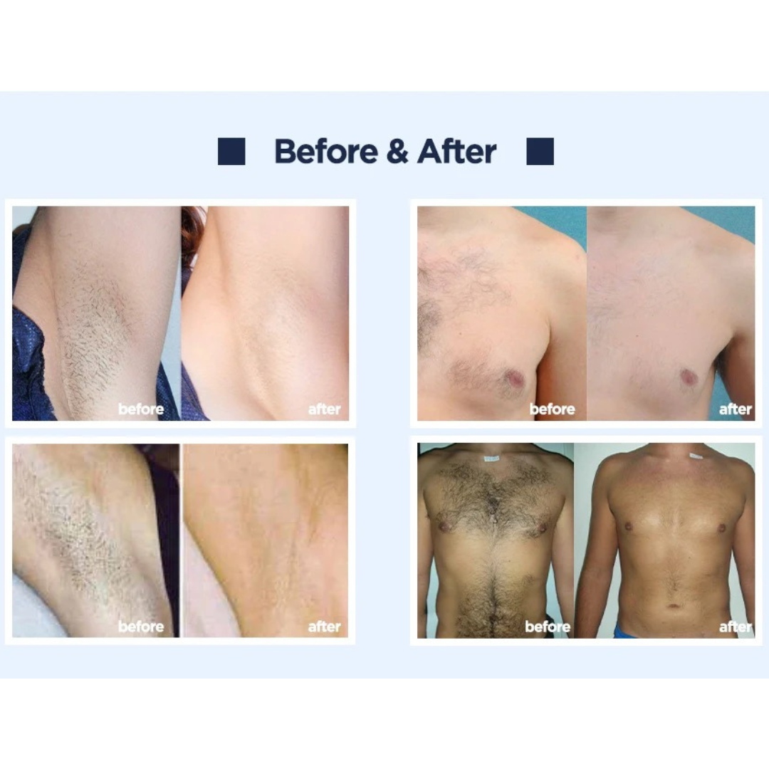 Athena 4D Laser Hair Removal Machine