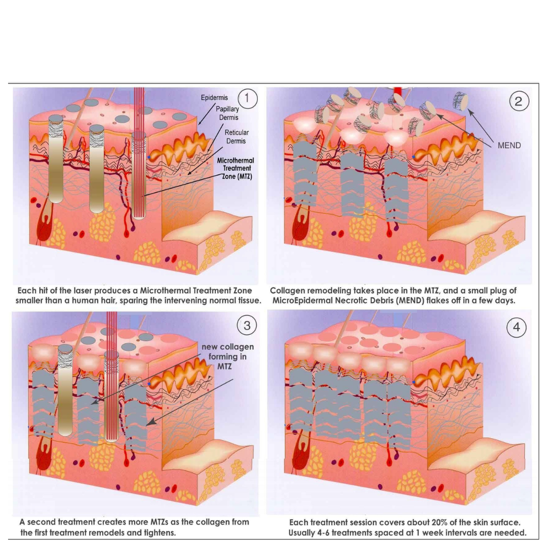 CoolPare™ EXPERT Fractional CO2 Laser