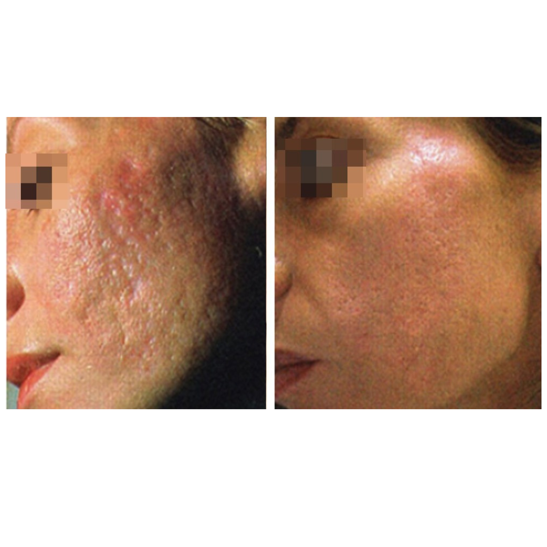 CoolPare™ EXPERT Fractional CO2 Laser