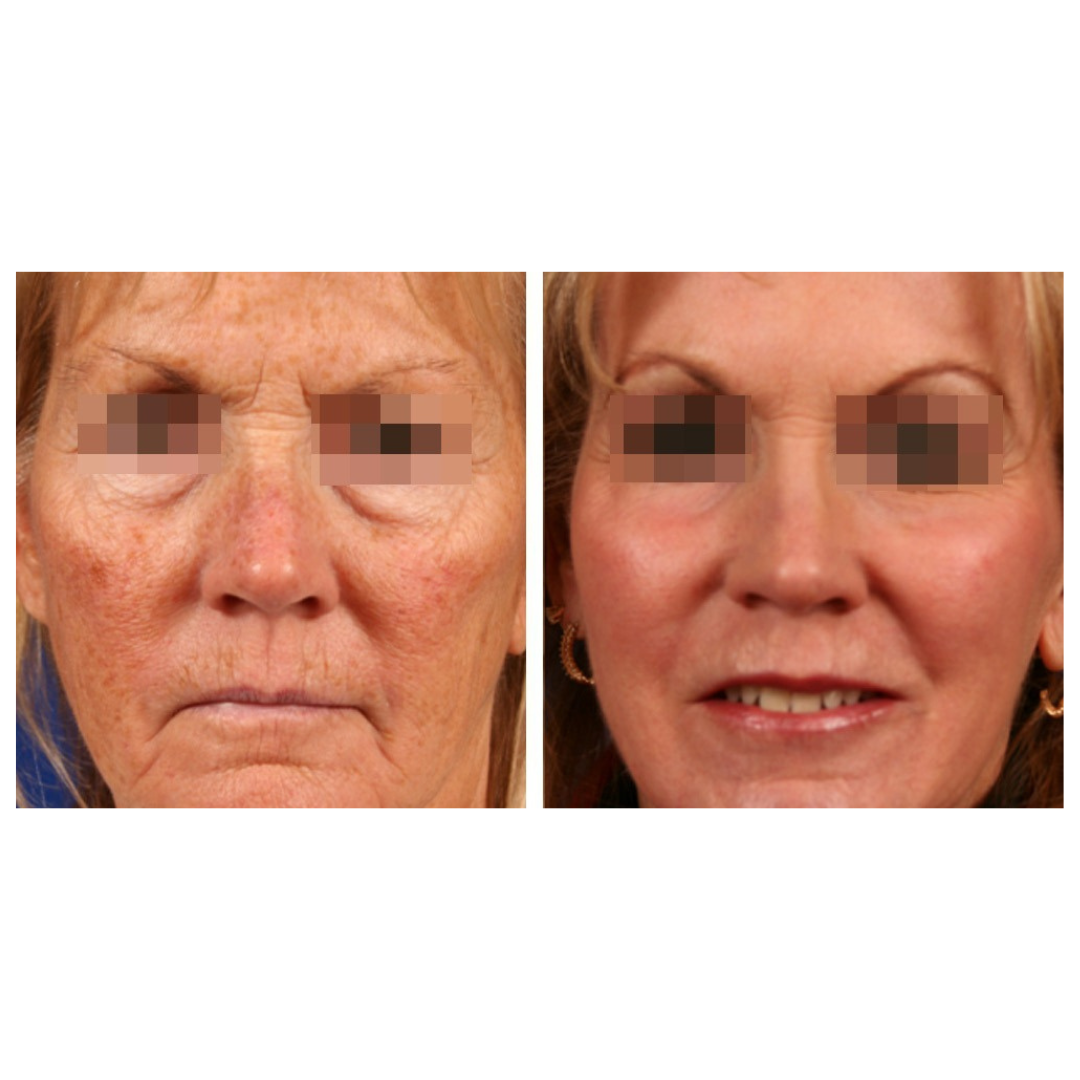 CoolPare™ EXPERT Fractional CO2 Laser