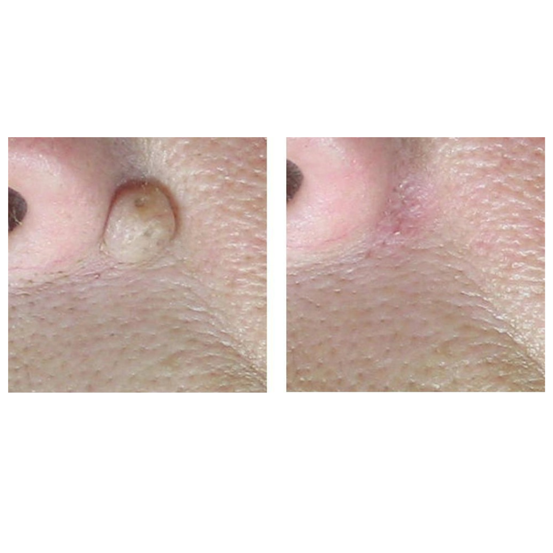 CoolPare™ EXPERT Fractional CO2 Laser