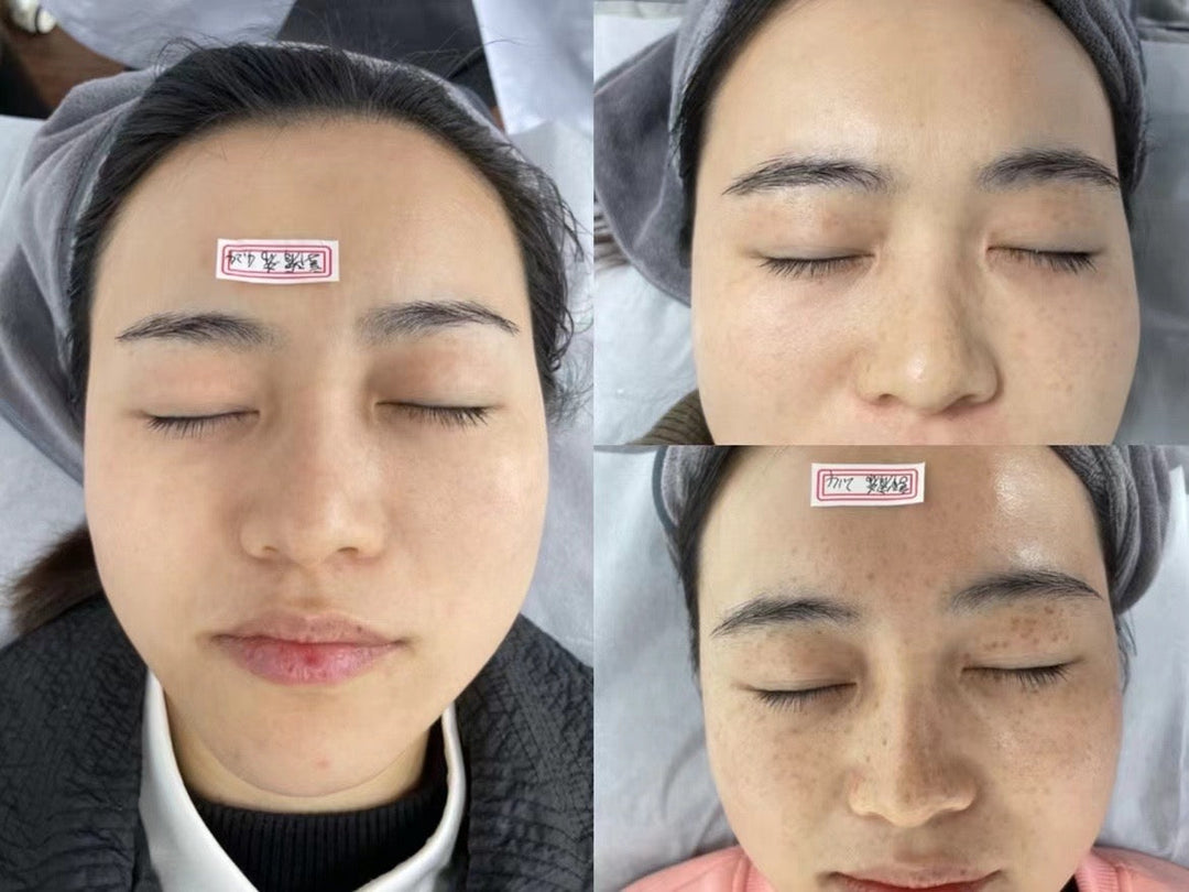 PicoPretty® Picosecond Laser - 4D Complete Pigment Solution
