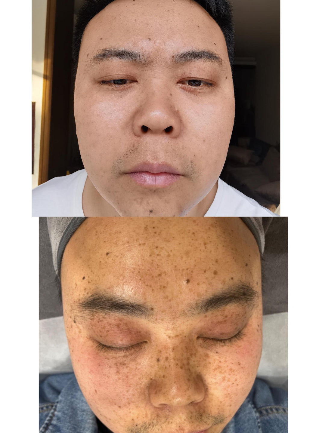 PicoPretty® Picosecond Laser - 4D Complete Pigment Solution