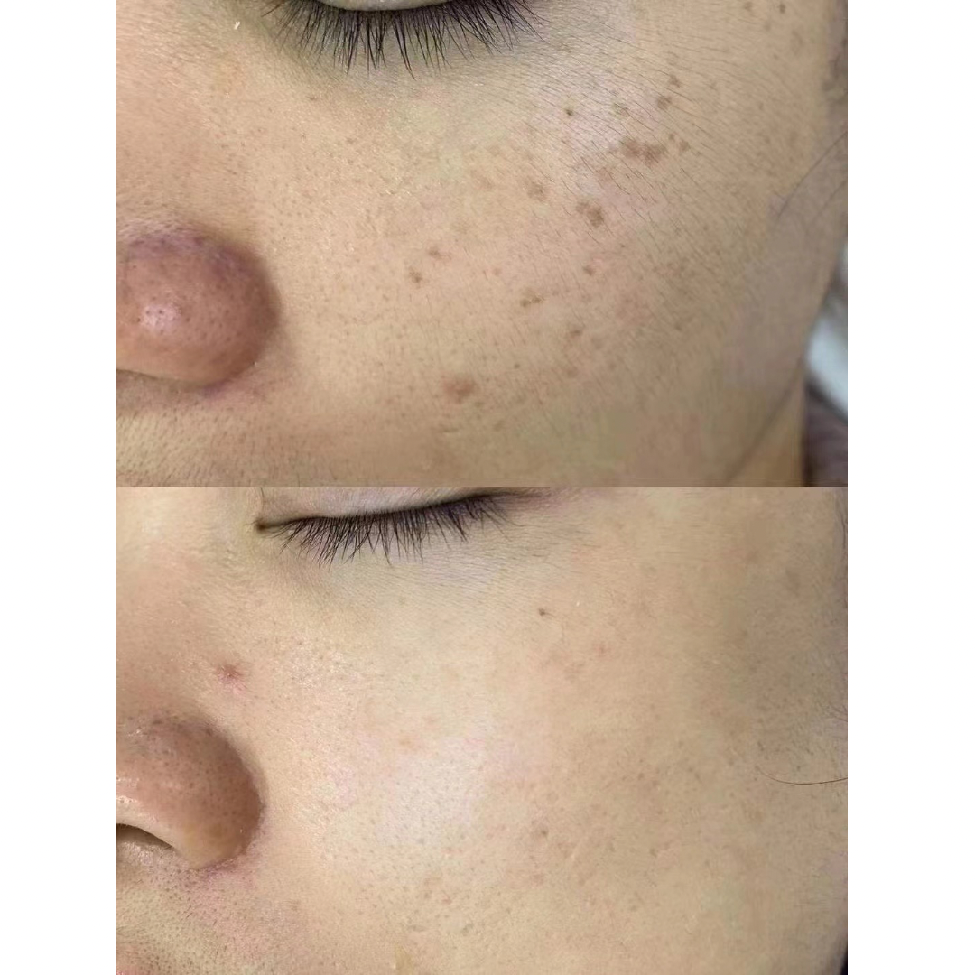 PicoElim™️ Tattoo Removal Laser Spot Master