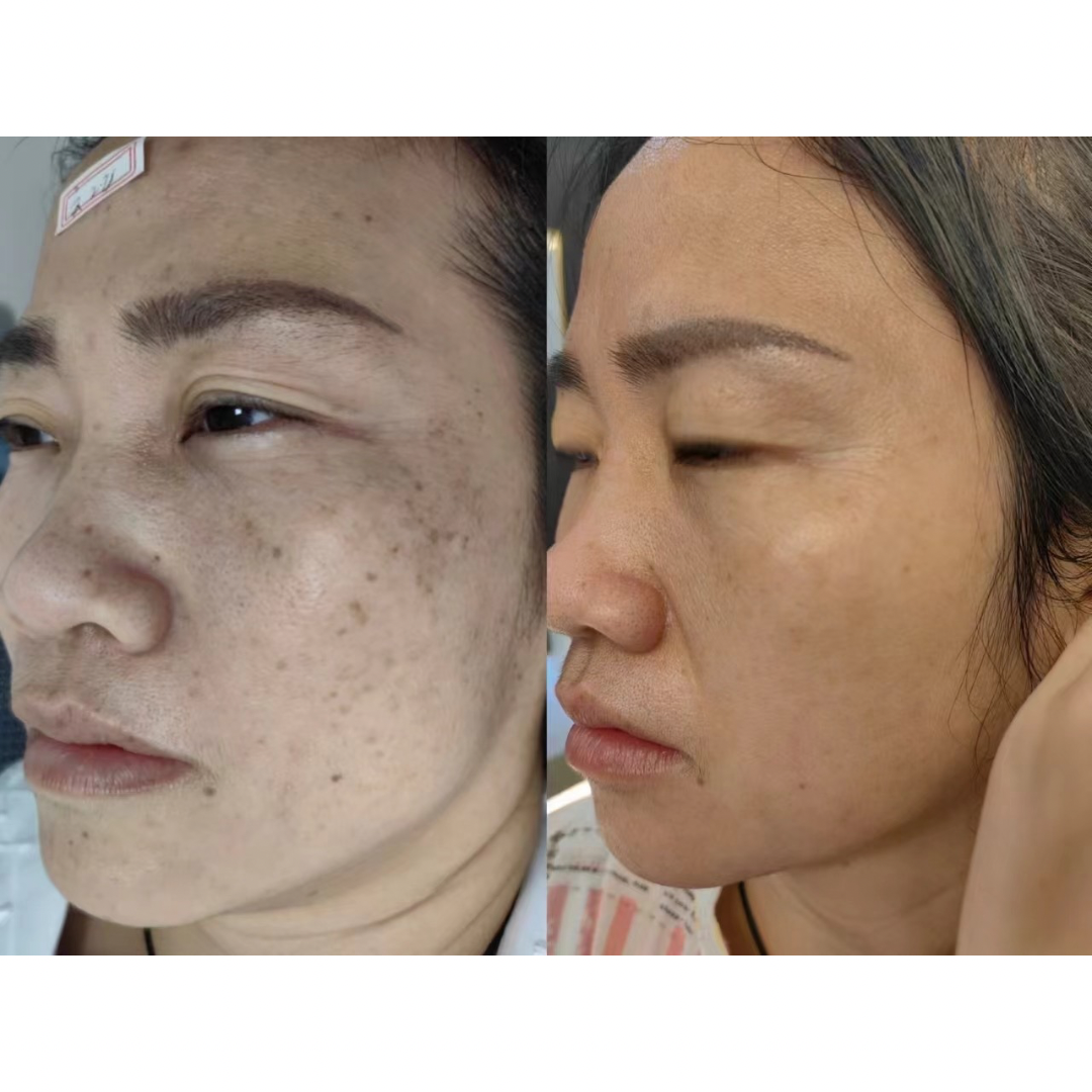 PicoElim™️ Tattoo Removal Laser Spot Master