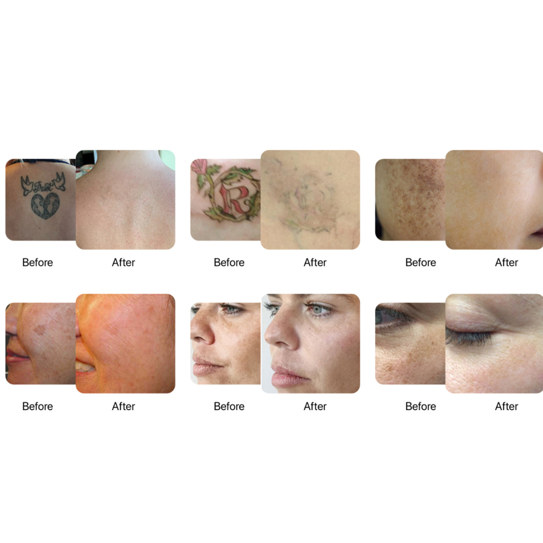 Dynamic 4 Wave Nano-Erase Tattoo Removal Laser Machine