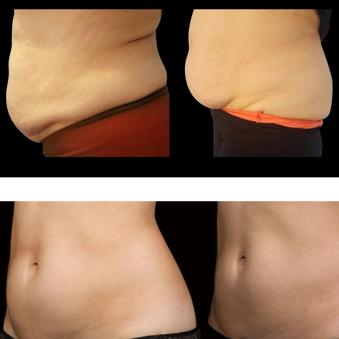 Eris Lipo Cavitación Máquina 6 en 1 Profesional