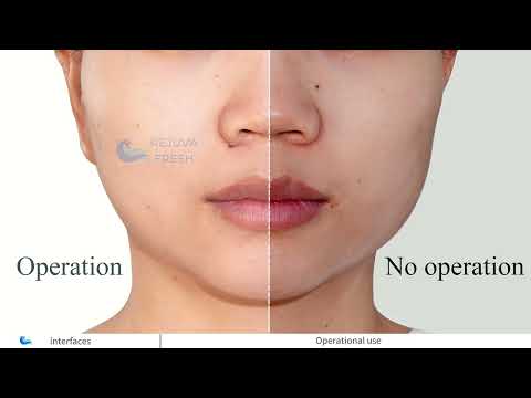 Metamorph 8.5 Golden Youth RF Microneedling Machine