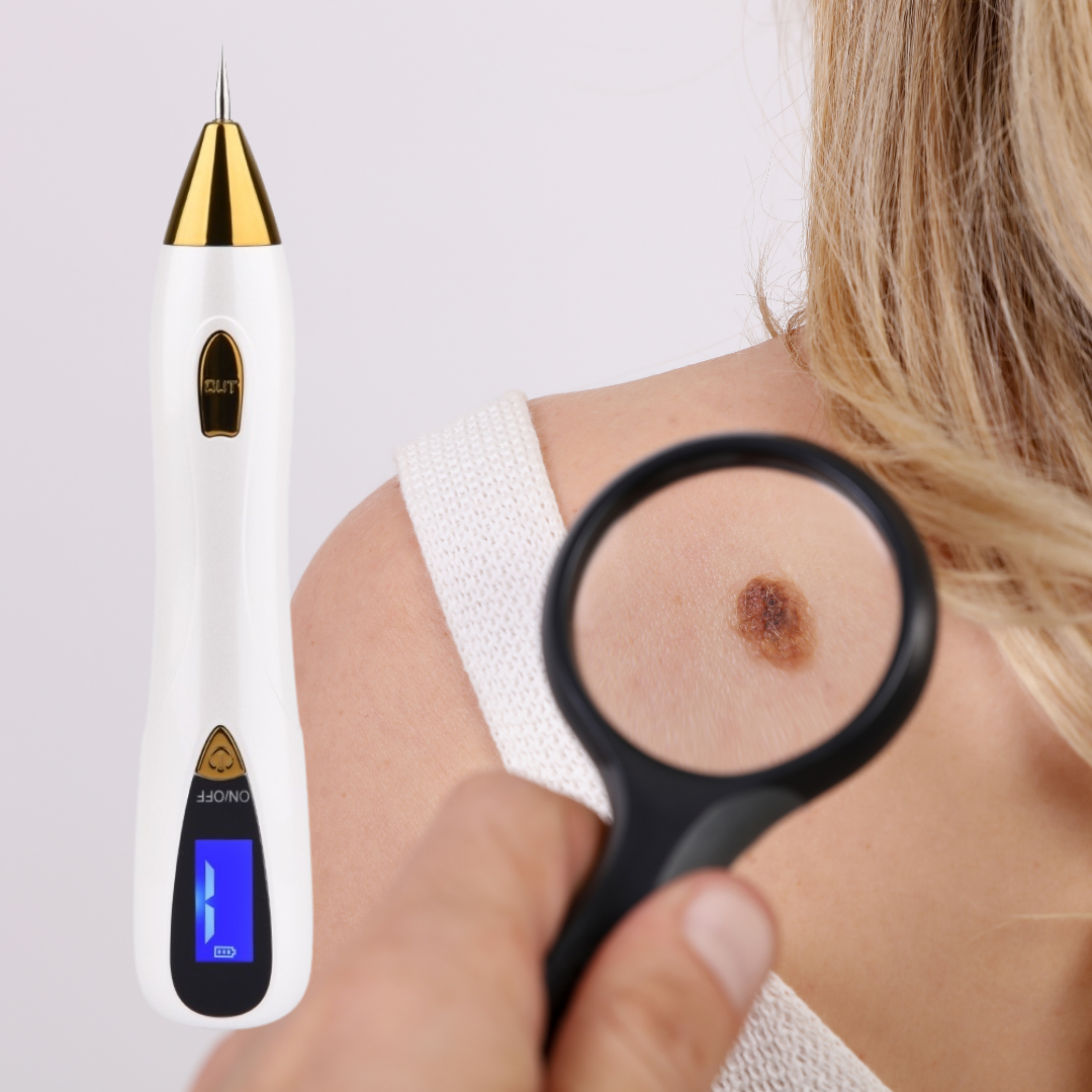 Skin Tag Removal Pen and Skin Tag on Back of Shoulder, Magnefying Glass