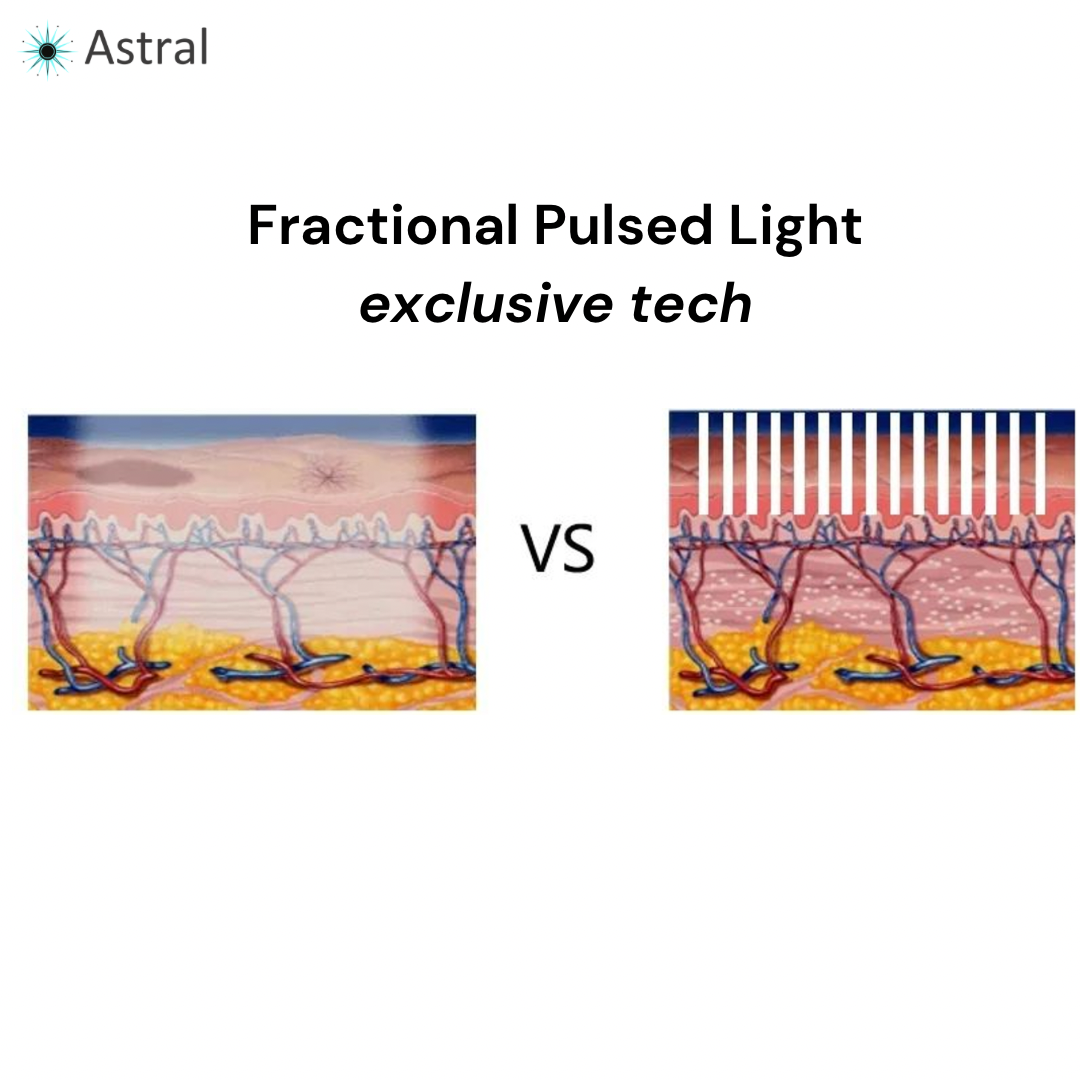 Astral F10 All-in-One Pulsed Light System- IPL + SHR + DPL + NIR + FPL