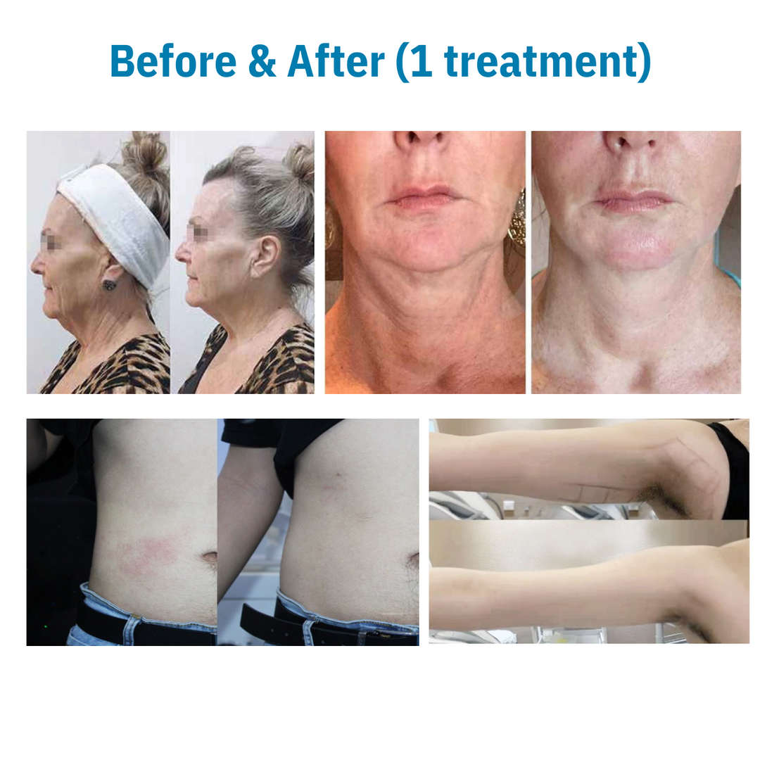 Rejuva 360 Ultra Formation Professional HIFU Machine for Body & Face
