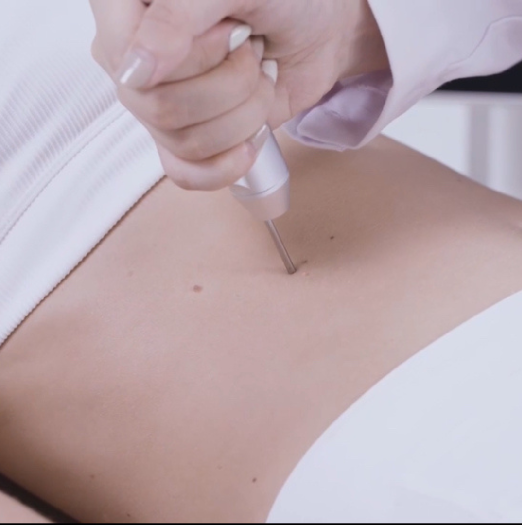 SmartPulse™ COOL Professional CO2 Fractional Laser