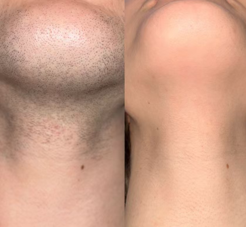 DuoSmooth™ 2-in-1 Diode Laser + IPL System