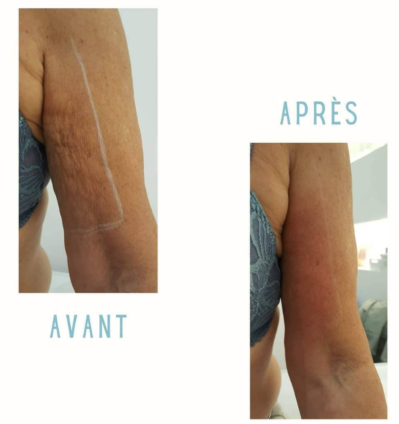 Reveal™ PRO SuperPulse CO2 Laser (Digital)