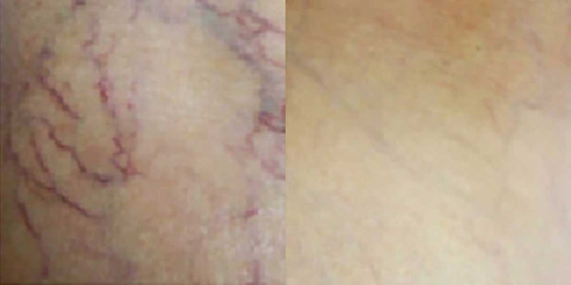 PicoPretty® Transform 3D