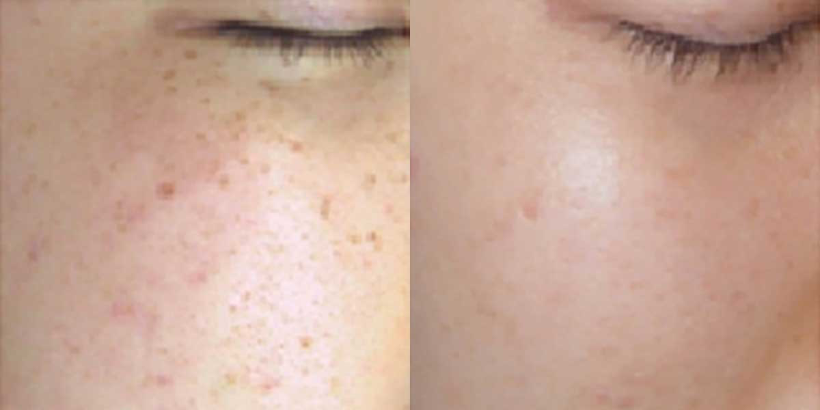 PicoPretty® Transform 3D