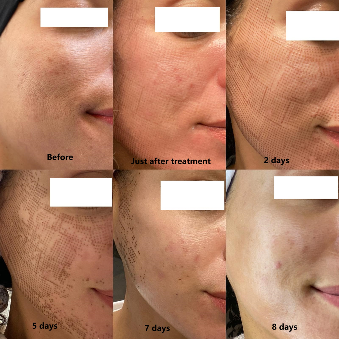 SmartPulse™ COOL Professional CO2 Fractional Laser