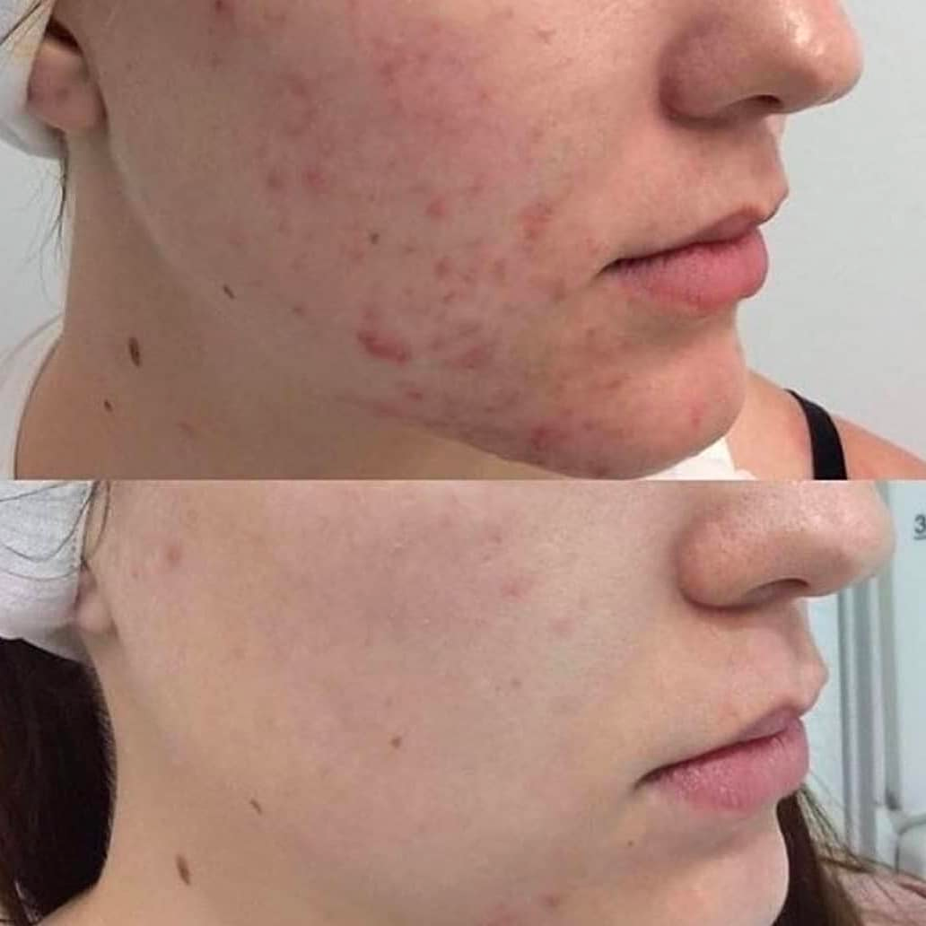 Metamorph8.5™ Golden Youth RF Microneedling Machine