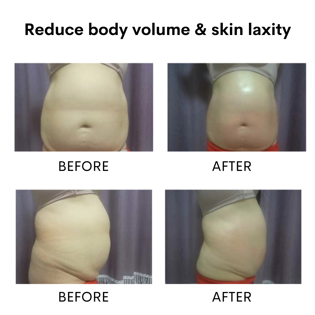 MultiNexis Body Remodeling System 6 in 1 | Body Contouring Machine ...