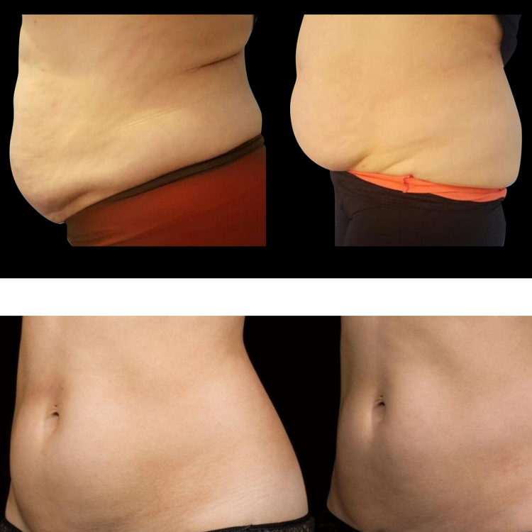 Before-and-after abdominal body contouring results shown from front and side views