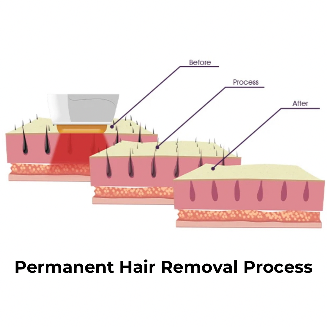 DuoSmooth™ 2-in-1 Diode Laser + IPL System